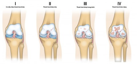 DỰ PHÒNG THOÁI HÓA KHỚP
