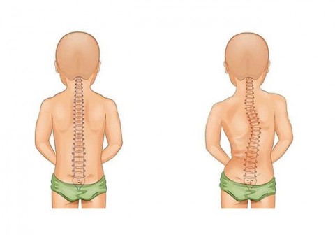VẸO CỘT SỐNG – HIỂU ĐÚNG ĐỂ CAN THIỆP KỊP THỜI