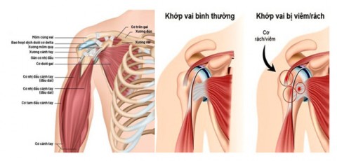 ảnh khớp vai