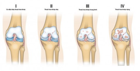 THOÁI HÓA KHỚP GỐI - HIỂU RÕ ĐỂ SỐNG KHỎE