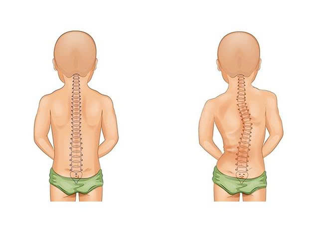 VẸO CỘT SỐNG – HIỂU ĐÚNG ĐỂ CAN THIỆP KỊP THỜI